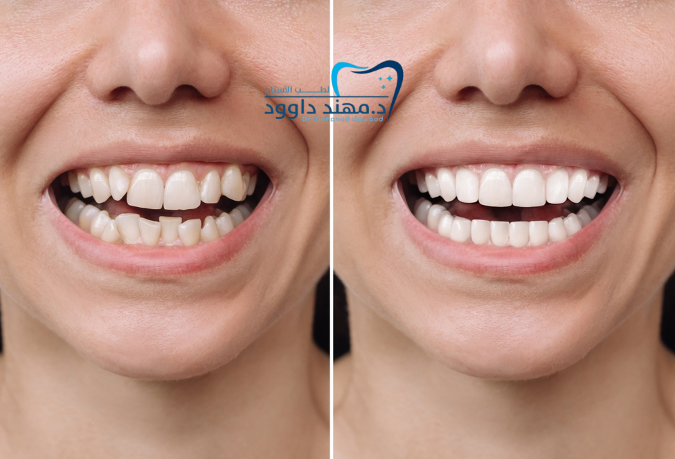ابتسامة هوليود قبل وبعد: دليل كامل لتجميل الأسنان: 0545378843