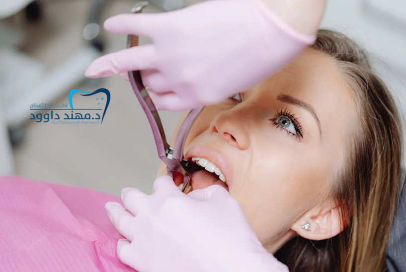 حشوة تجميلية للسن الامامي - عيادة الدكتور داوود: 0545378843