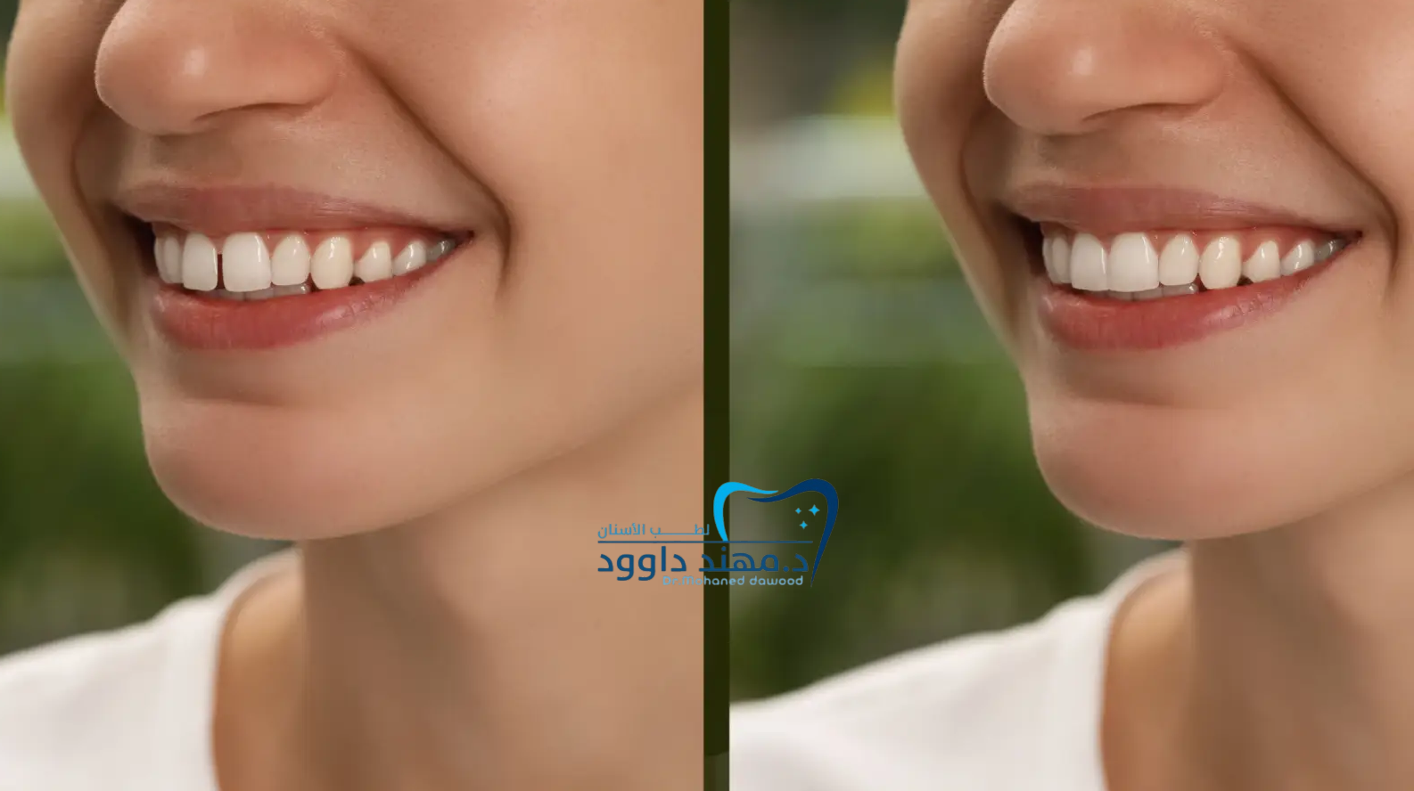 أفضل عيادة للحصول على ابتسامة هوليود في الرياض للرجال والنساء: 0545699624