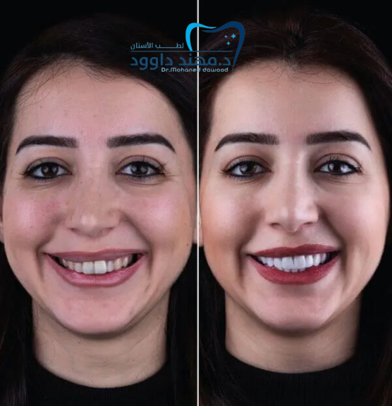 تجميل الأسنان قبل وبعد: 0545378843