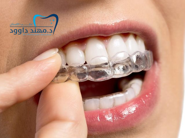 سعر قوالب تبييض الاسنان في العيادات: 0545378843