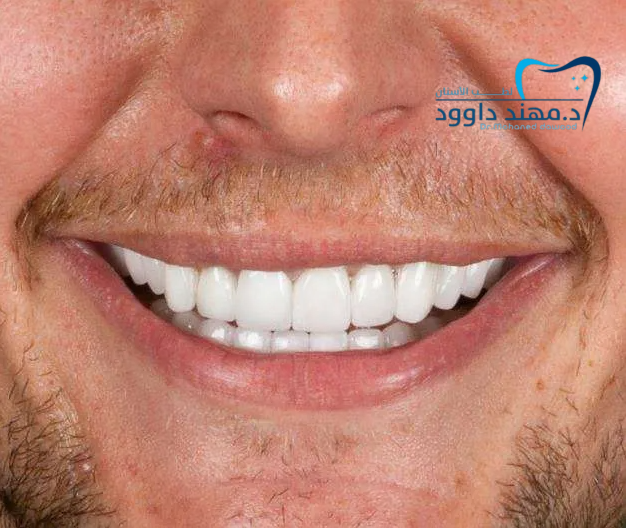 كم تكلفة عملية تجميل ابتسامة هوليود: 0545378843