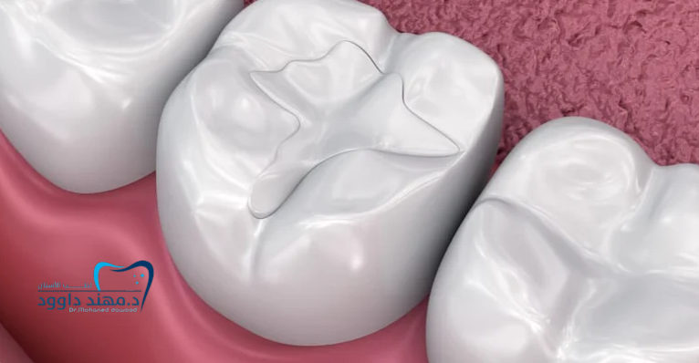 كيف أحافظ على الحشوات التجميلية: 0545378843