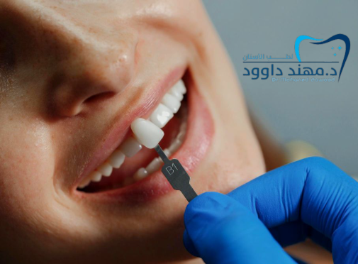 ماذا تعرف عن قشور الأسنان التجميلية: 0545378843