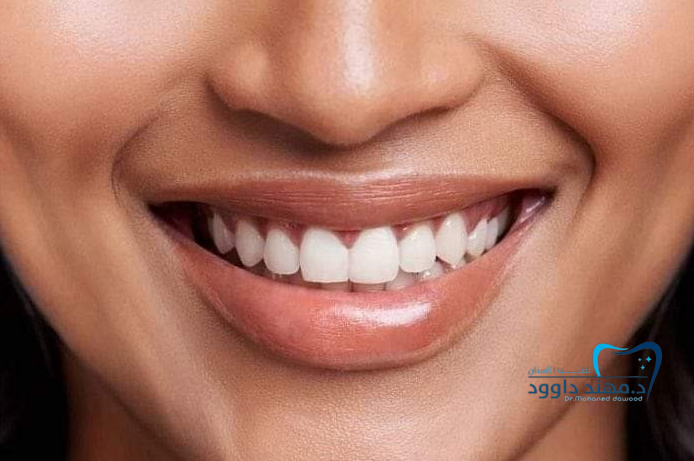 أسرار الحصول على ابتسامة هوليود بدون ألم وبنتائج مضمونة: 0566186262