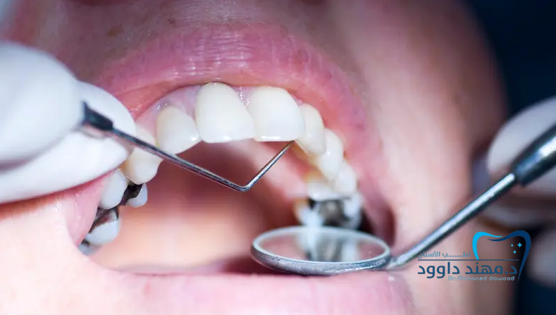 تجربتي مع الحشوات التجميلية: 0545378843