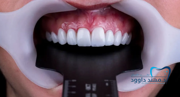 احصل على ابتسامة هوليود بأفضل سعر: 0545378843