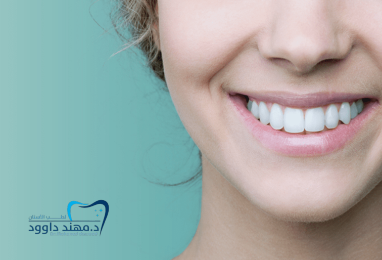 ابتسامة هوليود أو هوليود سمايل: دليل مفصل: 0545699624