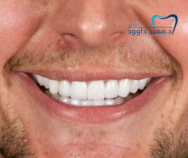 ابتسامة هوليود في الرياض – هل تستحق التجربة: 0566186262