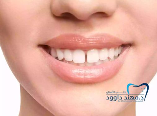 سد فراغات الأسنان وعلاج الكسور: 0545378843