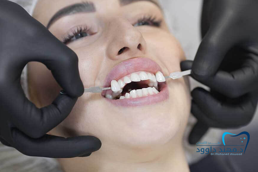 ابتسامة هوليود: الفرق بين الفينير واللومينير — وأيهما يناسبك: 0545699624