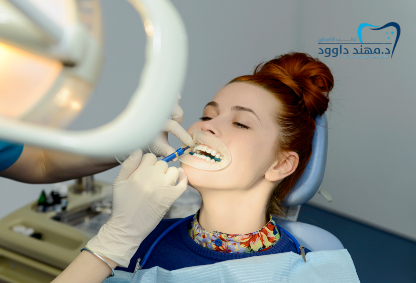 دليل شامل عن أفضل عدسات الأسنان التجميلية 2025: احصل على ابتسامة هوليود: 0545699624