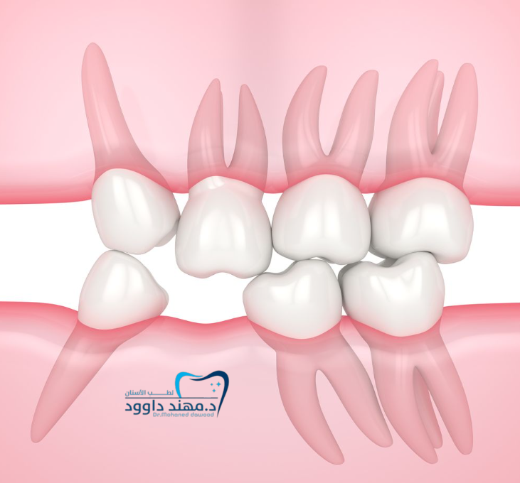 تعرف على سعر الحشوات التجميلية لسد الفراغات: 0545699624