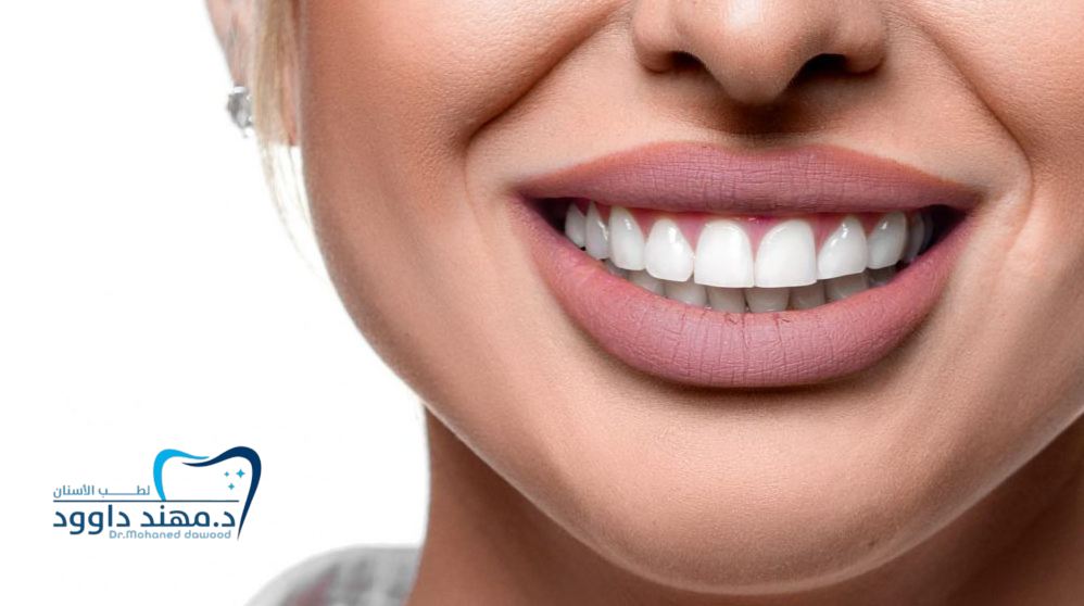 ابتسامة هوليود قبل وبعد – صور وتجارب حقيقية بعد التجميل في الرياض