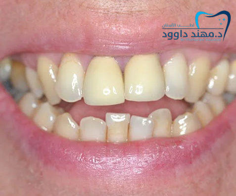 حشوات تجميلية لملء فراغات الأسنان