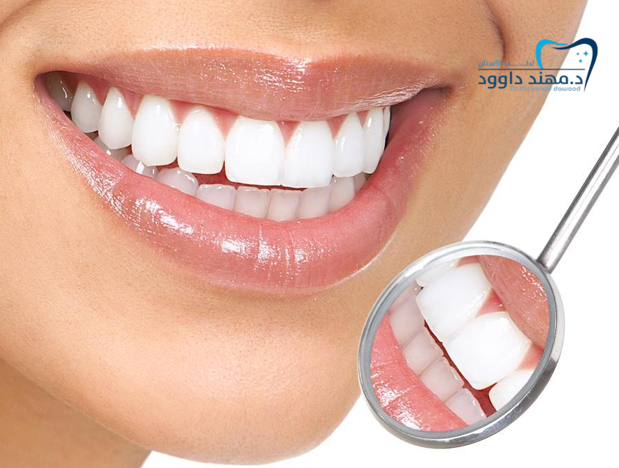 حشوات تجميلية لملء فراغات الأسنان