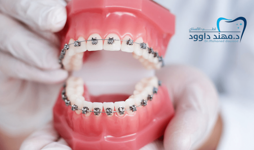 تقويم الأسنان قبل وبعد وما هو السن المناسب للتقويم