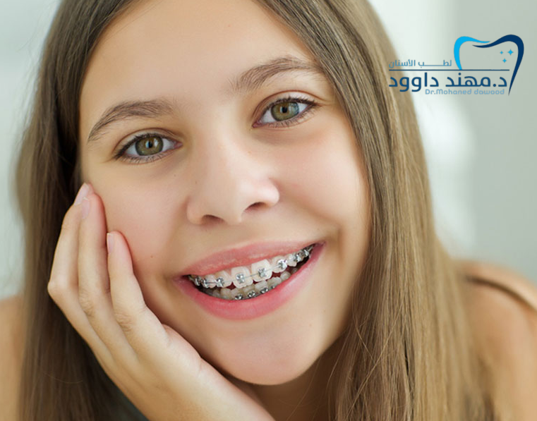 تقويم الأسنان قبل وبعد وما هو السن المناسب للتقويم