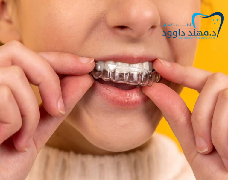 تقويم الأسنان قبل وبعد وما هو السن المناسب للتقويم
