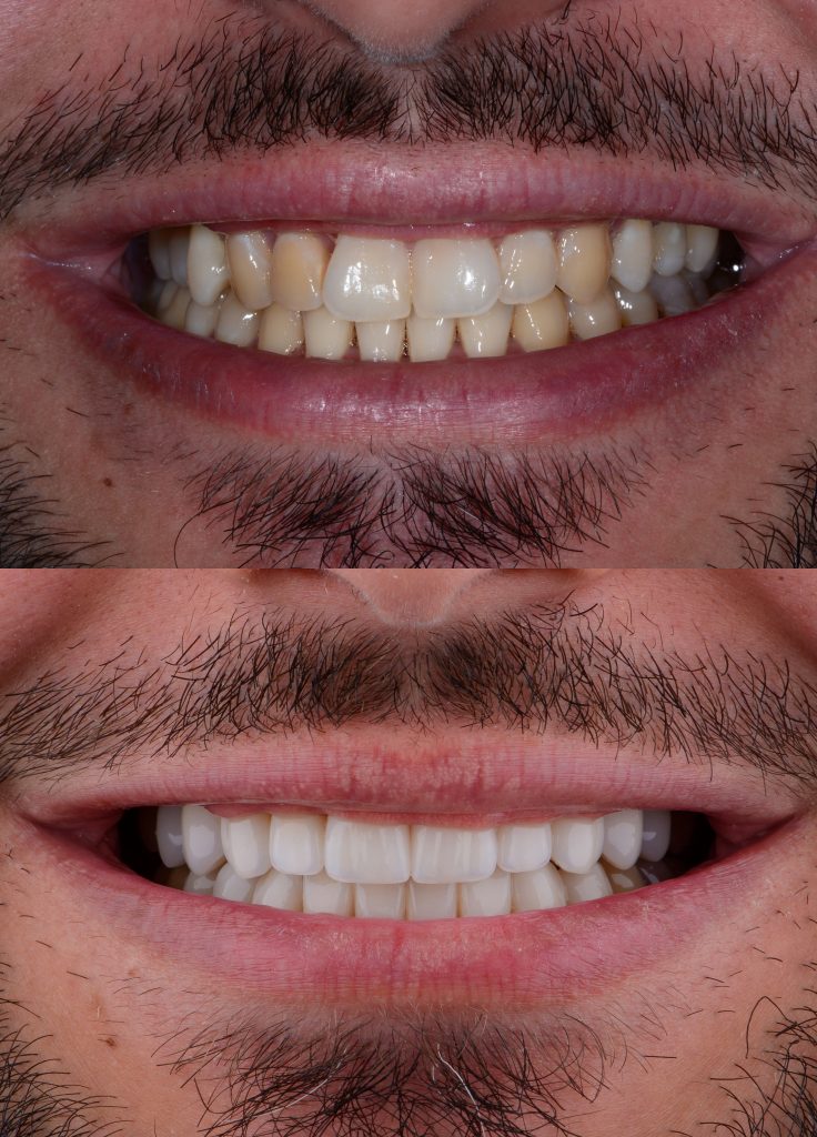 تلميع الاسنان قبل وبعد