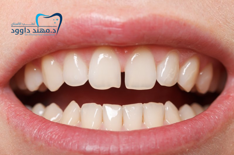 تكلفة الحشوات التجميلية لسد الفراغات في الرياض 2025: 0545699624