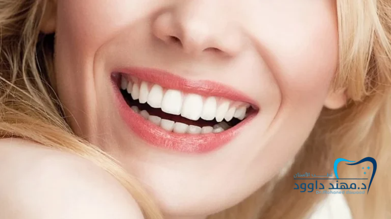 ابتسامة هوليود أو هوليود سمايل: دليل مفصل: 0545699624