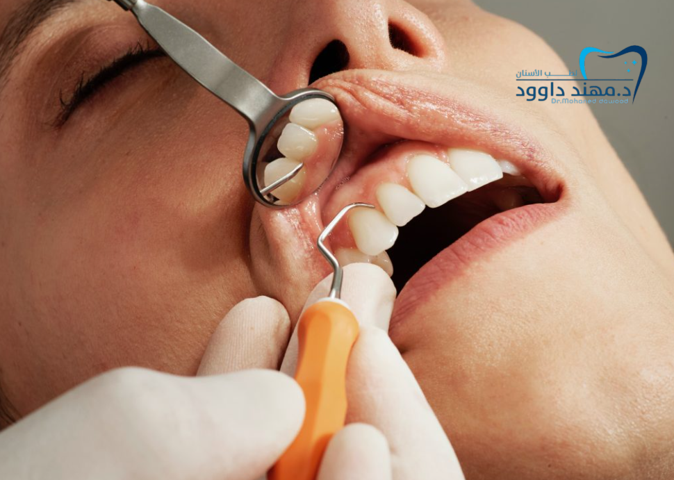 ما هي أفضل الحشوات التجميلية للأسنان الأمامية؟ مقارنة بين الأنواع: 0545699624