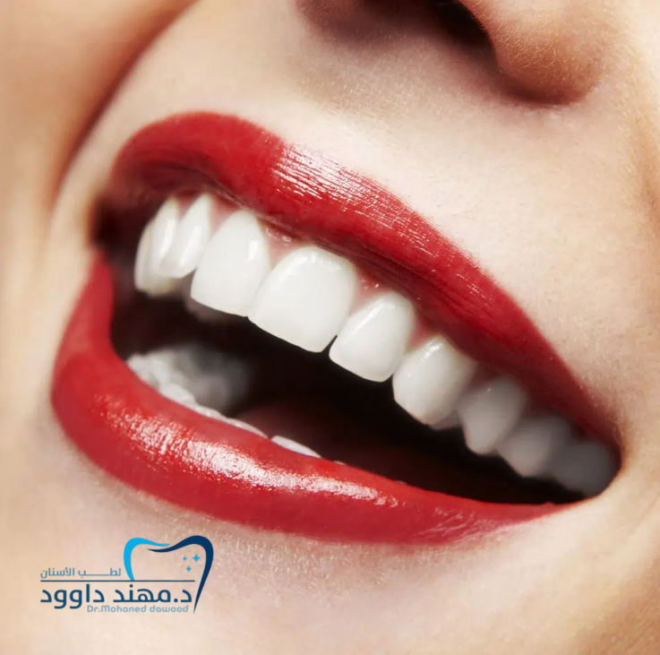 ماهي أسعار تركيب ابتسامة هوليود في السعودية: 0545699624