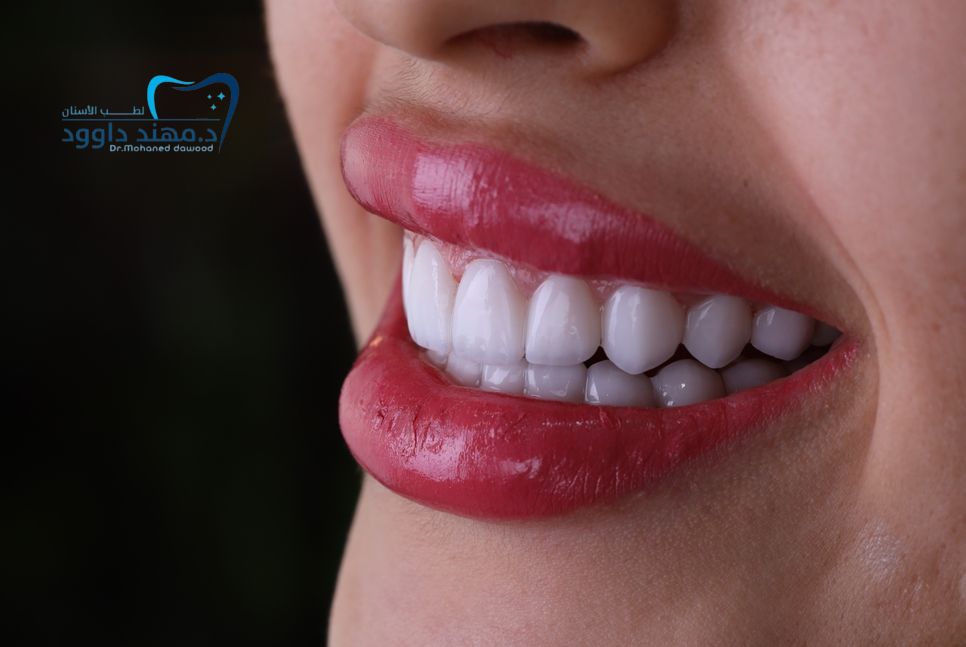 خطوات الحصول على ابتسامة هوليود في الرياض من أول زيارة حتى النتيجة النهائية: 0566186262