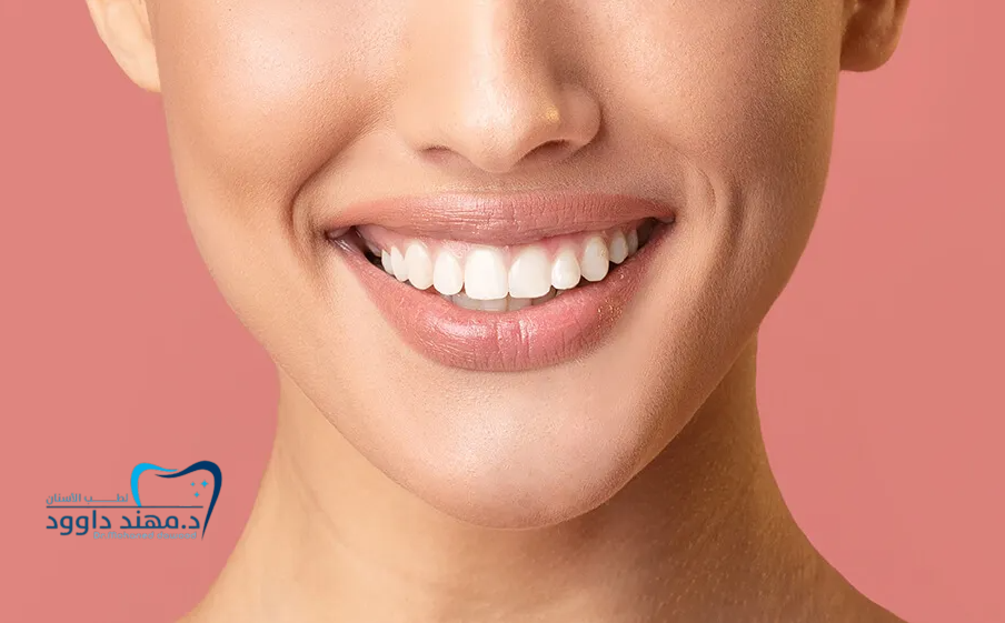 تجميل الأسنان بالفينير: 0545378843