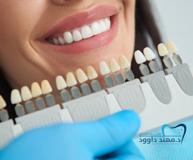 تكلفة الفينير في السعودية: 0545699624
