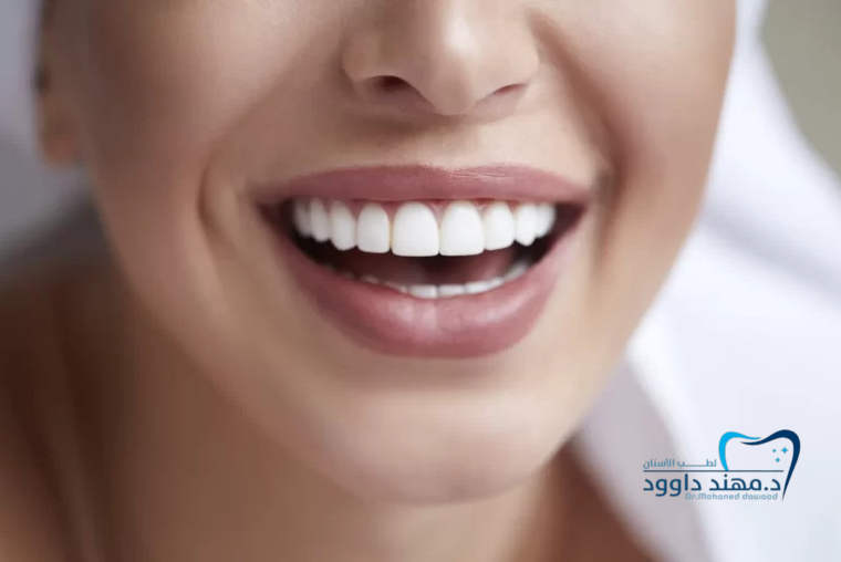 خطوات تركيب قشرة الأسنان للحصول على ابتسامة هوليود في أقل من أسبوع: 0545699624