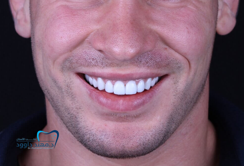 خطوات تركيب قشرة الأسنان للحصول على ابتسامة هوليود في أقل من أسبوع: 0545699624
