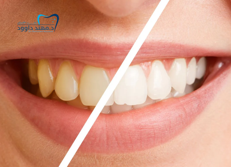 تبييض الأسنان بالليزر في الرياض – نتائج مذهلة من أول جلسة: 0566186262