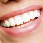 تلميع الاسنان قبل وبعد