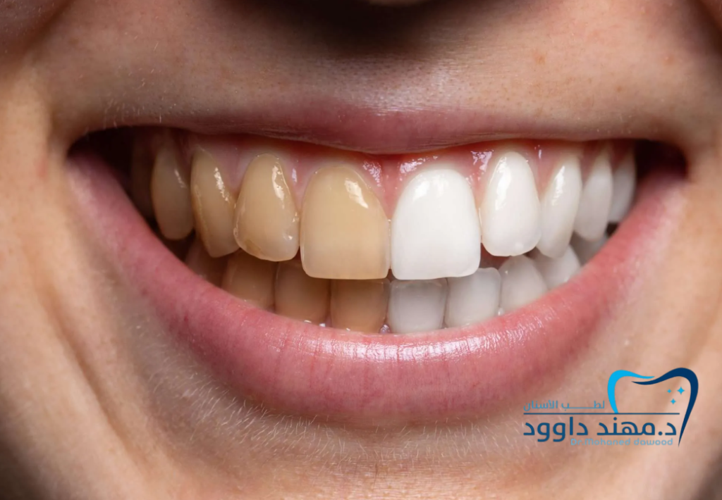 وين أحصل تبييض أسنان احترافي في الرياض: 0566186262