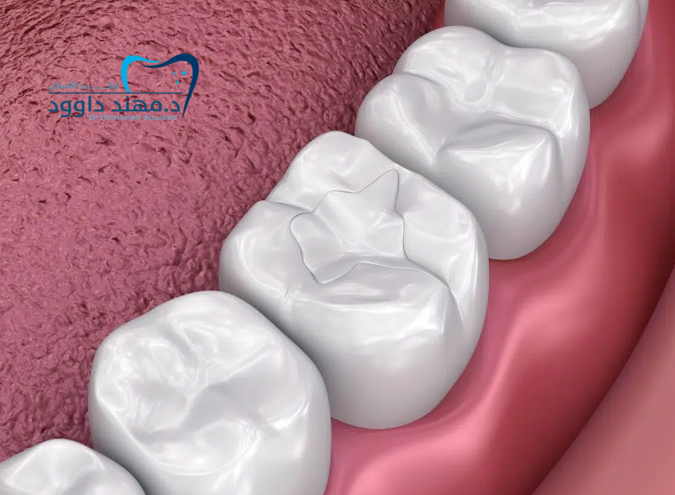 كم سعر الحشوات البيضاء التجميلية بالرياض: 0566186262