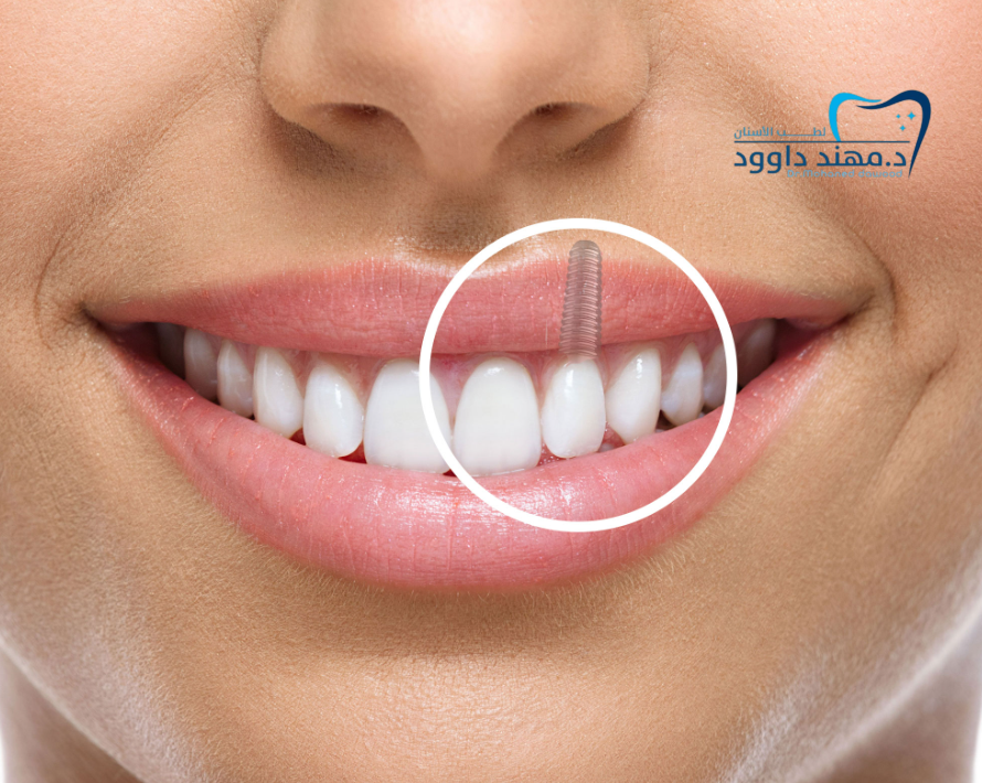 زراعة الأسنان الأمامية بالرياض: 0566186262