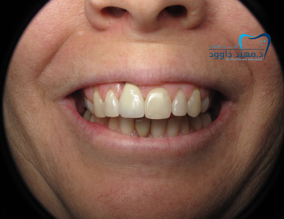 زراعة الأسنان الأمامية بالرياض: 0566186262