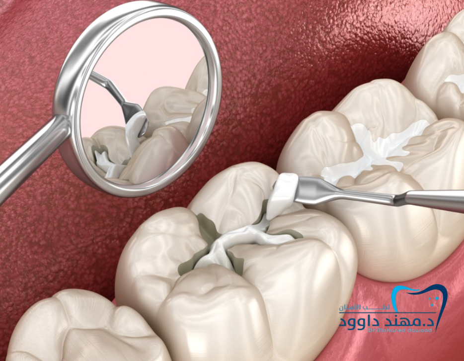 افضل عيادة اسنان بالرياض للحشوات: 0545378843
