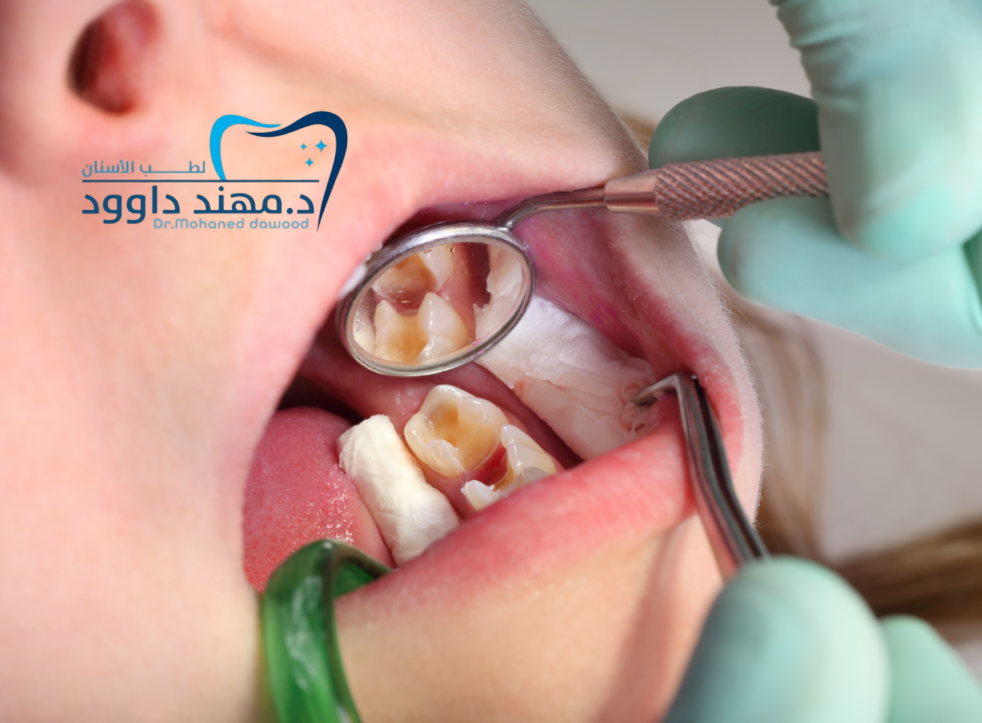 افضل عيادة اسنان بالرياض للحشوات: 0545378843