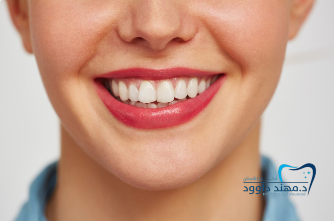أفضل دكتور فينير أسنان في الرياض: 0545378843