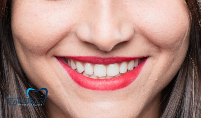 ابتسامة هوليوود المتحركة: ما يجب معرفته قبل الحصول عليها: 0545378843